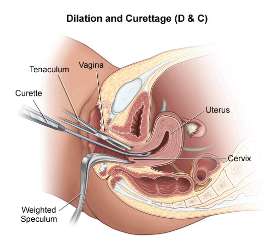 Dilation and Curetage FINAL Graphic for Dilation and Curetage