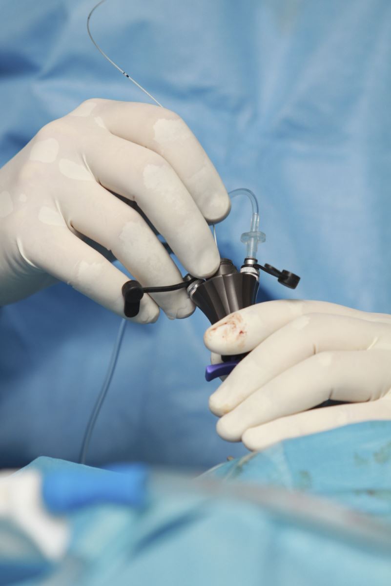 Laparoscopy Laparoscopy
