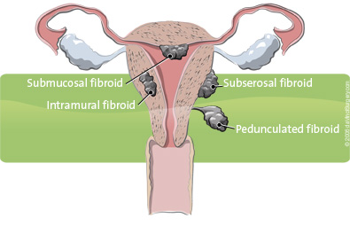 fibroids_395x255 Picture of fibroids
