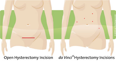incision-comparison-hyst07-05 daVinci Hysterectomy Incision and open Hysterectomy Incision comparison